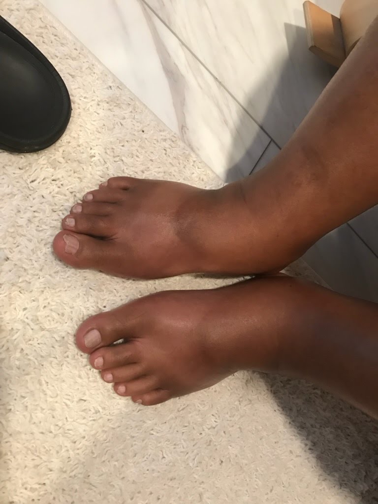Swelling in Brian's feet, documented before he began PEMF sessions